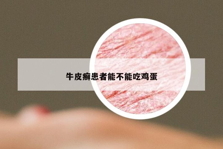 牛皮癣患者能不能吃鸡蛋