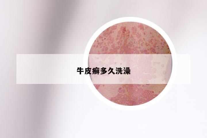 牛皮癣多久洗澡
