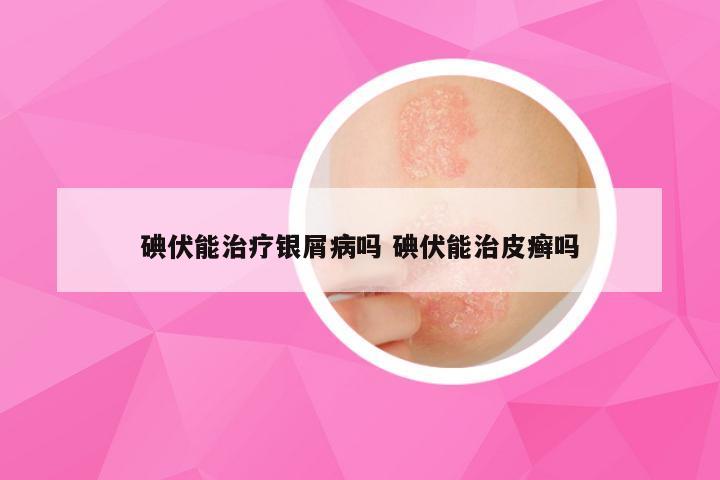 碘伏能治疗银屑病吗 碘伏能治皮癣吗