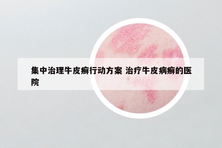 集中治理牛皮癣行动方案 治疗牛皮病癣的医院