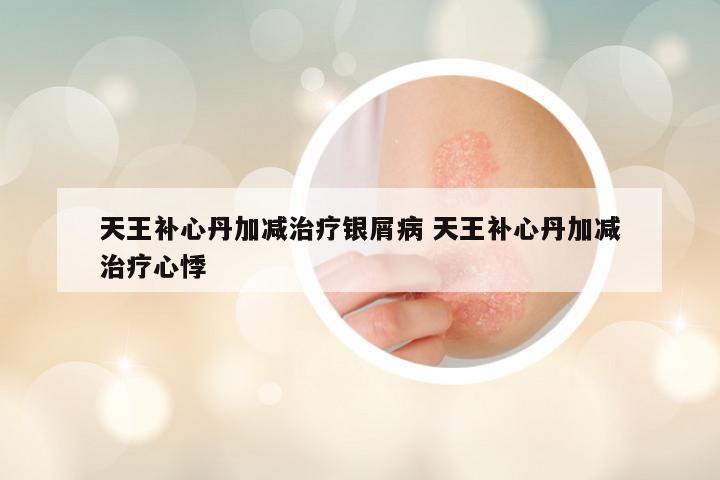 天王补心丹加减治疗银屑病 天王补心丹加减治疗心悸