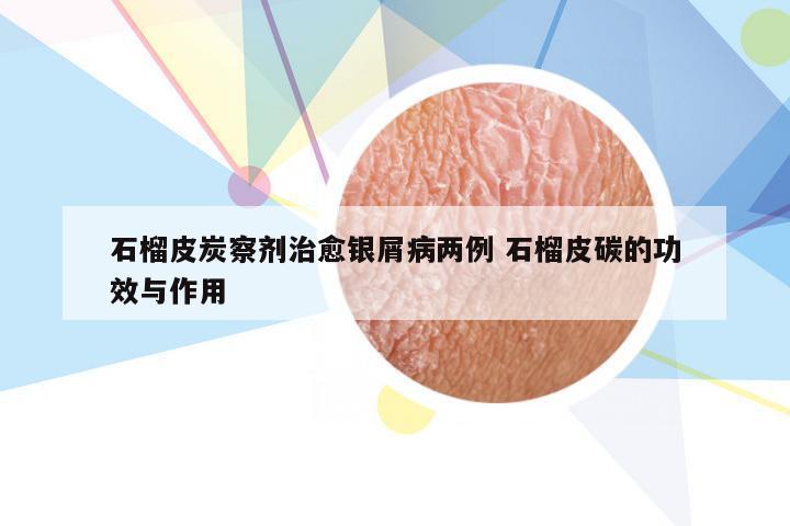 石榴皮炭察剂治愈银屑病两例 石榴皮碳的功效与作用