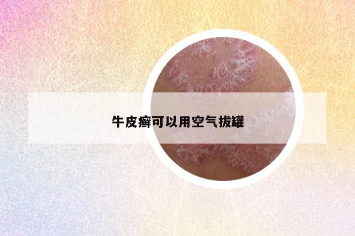 牛皮癣可以用空气拔罐