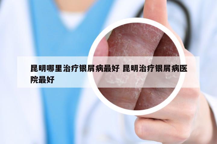 昆明哪里治疗银屑病最好 昆明治疗银屑病医院最好