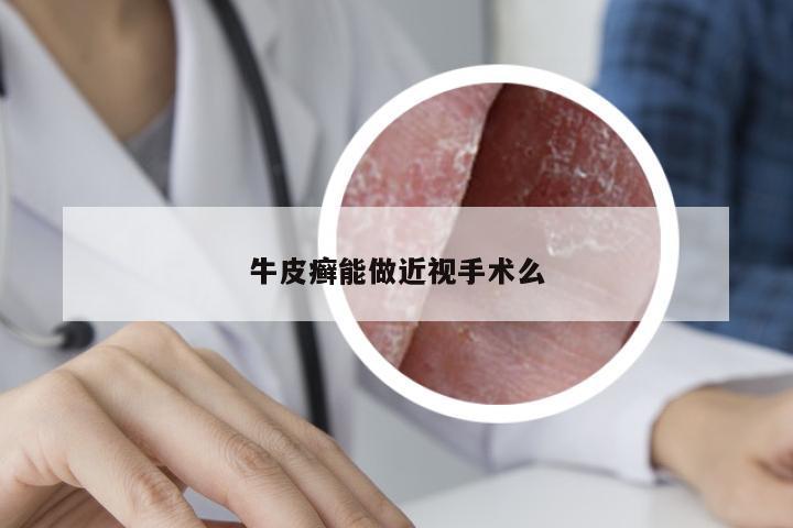 牛皮癣能做近视手术么