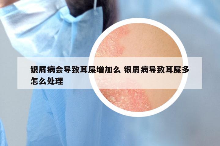 银屑病会导致耳屎增加么 银屑病导致耳屎多怎么处理