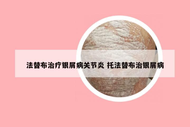 法替布治疗银屑病关节炎 托法替布治银屑病
