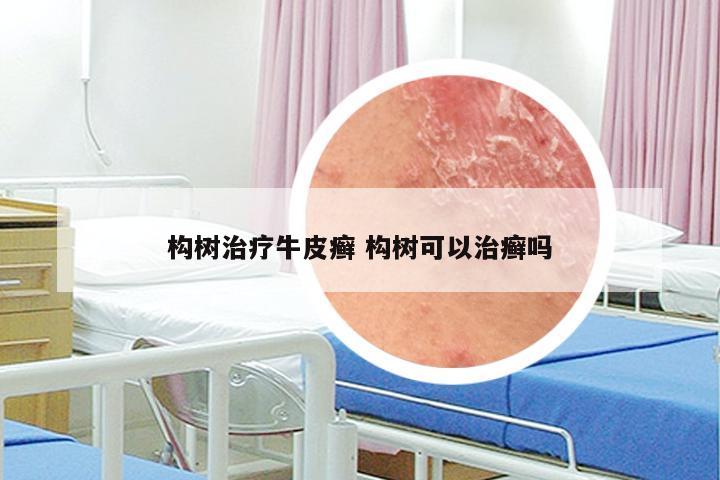 构树治疗牛皮癣 构树可以治癣吗
