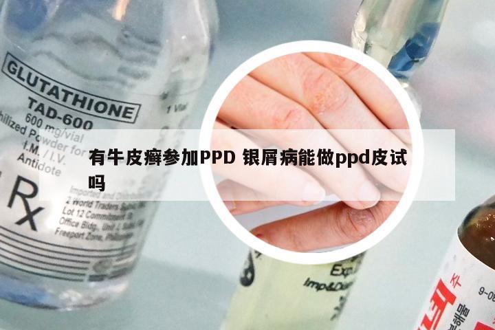 有牛皮癣参加PPD 银屑病能做ppd皮试吗