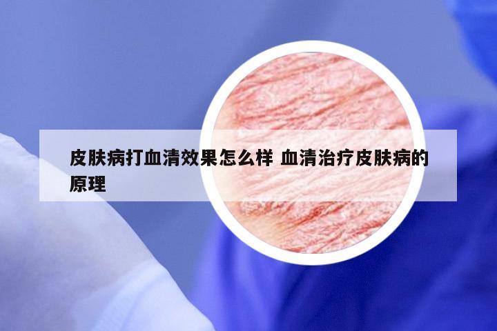皮肤病打血清效果怎么样 血清治疗皮肤病的原理