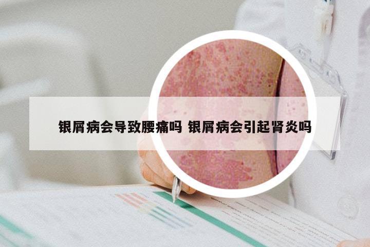 银屑病会导致腰痛吗 银屑病会引起肾炎吗