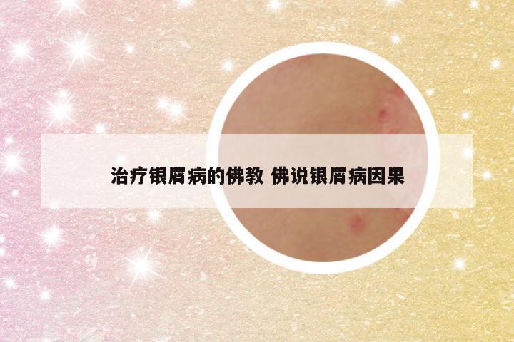 治疗银屑病的佛教 佛说银屑病因果