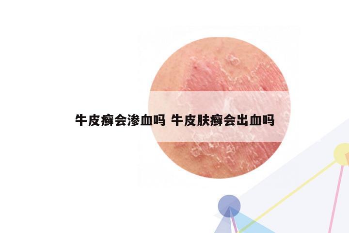 牛皮癣会渗血吗 牛皮肤癣会出血吗 - 东方皮肤网