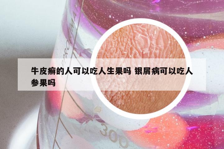 牛皮癣的人可以吃人生果吗 银屑病可以吃人参果吗