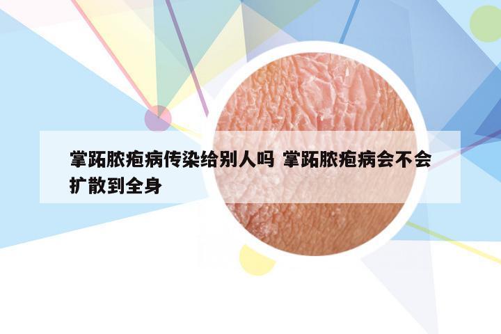 掌跖脓疱病传染给别人吗 掌跖脓疱病会不会扩散到全身