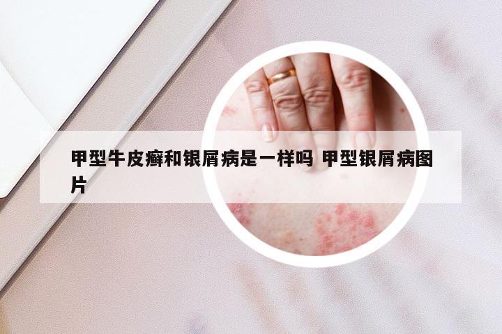 甲型牛皮癣和银屑病是一样吗 甲型银屑病图片
