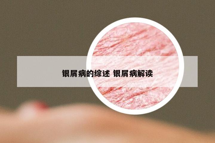银屑病的综述 银屑病解读