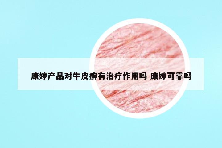 康婷产品对牛皮癣有治疗作用吗 康婷可靠吗