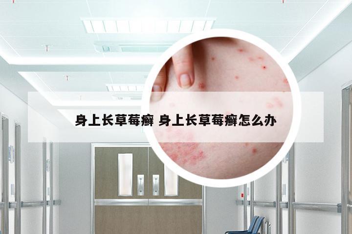身上长草莓癣 身上长草莓癣怎么办