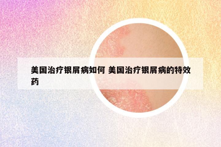 美国治疗银屑病如何 美国治疗银屑病的特效药