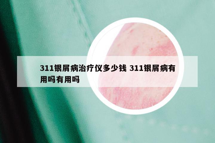 311银屑病治疗仪多少钱 311银屑病有用吗有用吗