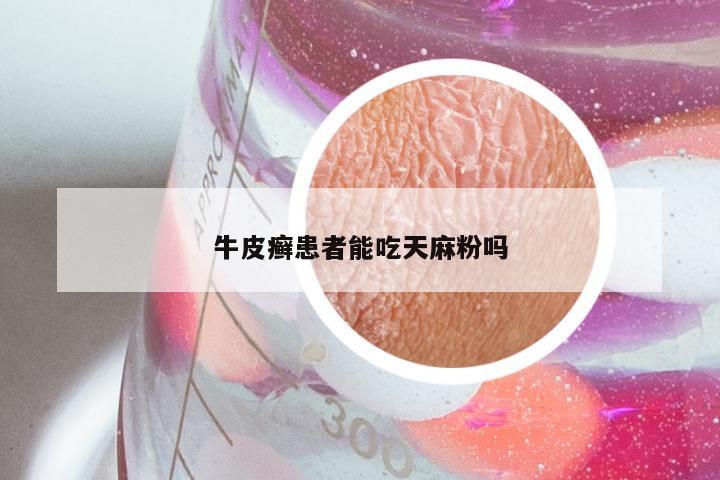 牛皮癣患者能吃天麻粉吗