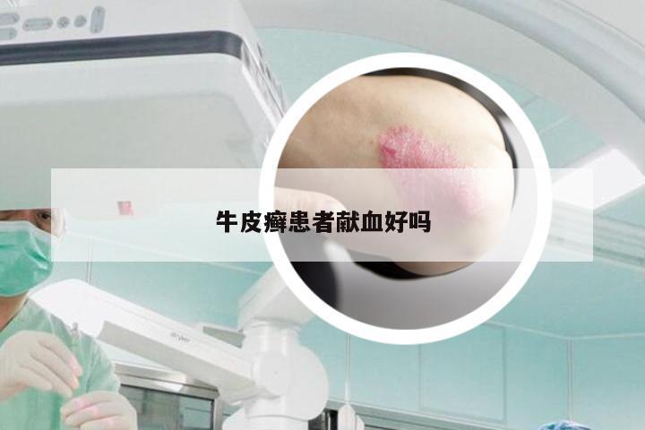 牛皮癣患者献血好吗