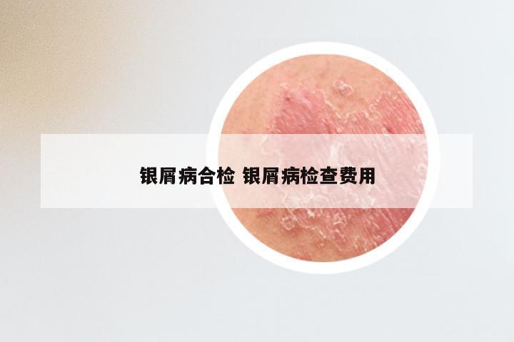 银屑病合检 银屑病检查费用