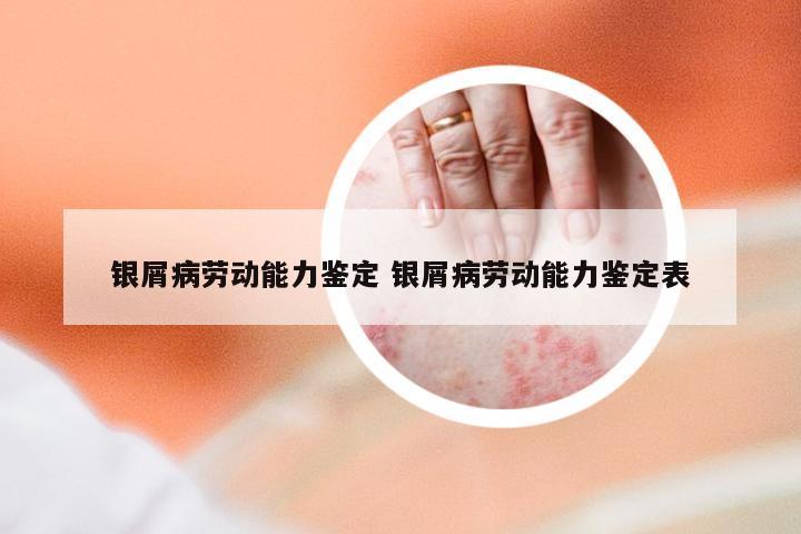 银屑病劳动能力鉴定 银屑病劳动能力鉴定表