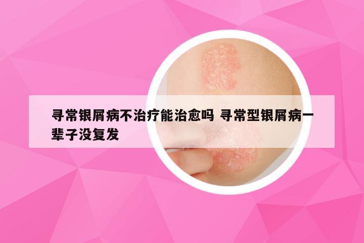 寻常银屑病不治疗能治愈吗 寻常型银屑病一辈子没复发