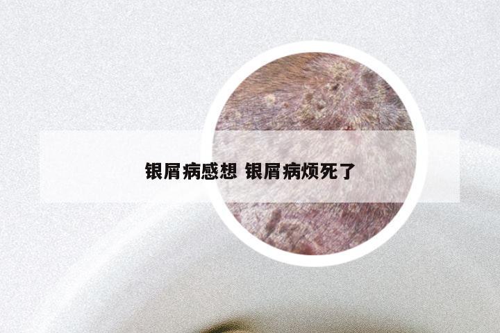 银屑病感想 银屑病烦死了