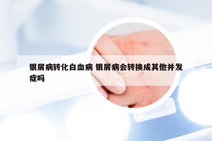 银屑病转化白血病 银屑病会转换成其他并发症吗
