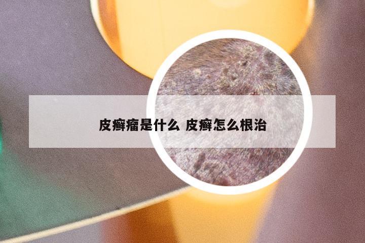 皮癣瘤是什么 皮癣怎么根治