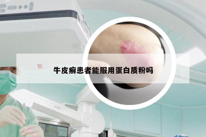 牛皮癣患者能服用蛋白质粉吗