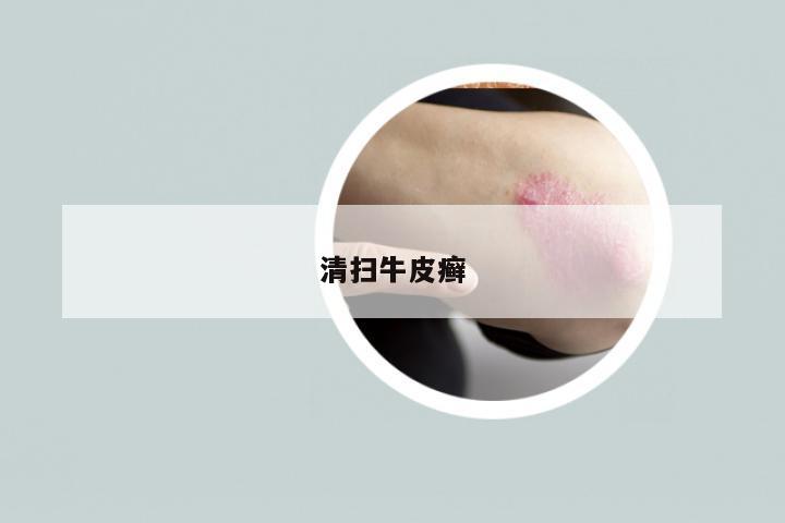 清扫牛皮癣