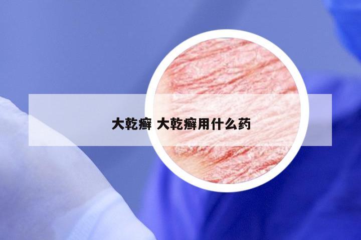 大乾癣 大乾癣用什么药