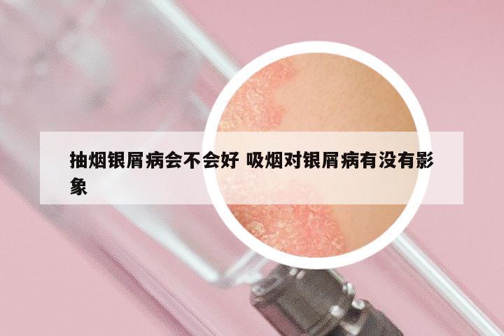 抽烟银屑病会不会好 吸烟对银屑病有没有影象