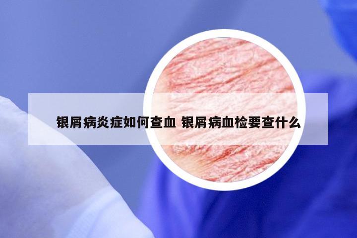 银屑病炎症如何查血 银屑病血检要查什么
