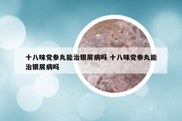 十八味党参丸能治银屑病吗 十八味党参丸能治银屑病吗
