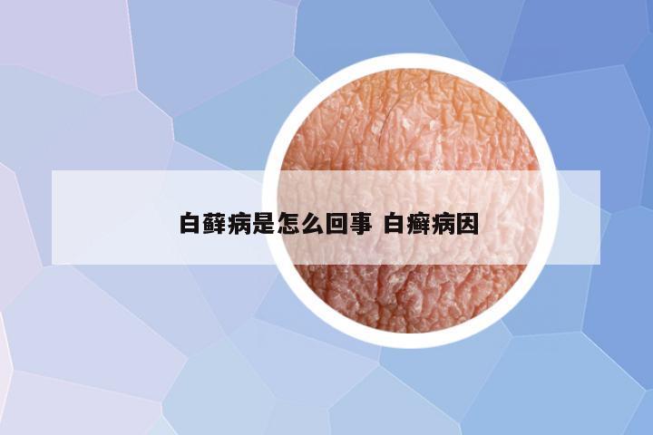 白藓病是怎么回事 白癣病因