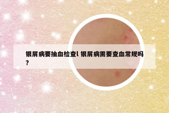 银屑病要抽血检查l 银屑病需要查血常规吗?