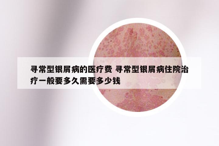 寻常型银屑病的医疗费 寻常型银屑病住院治疗一般要多久需要多少钱