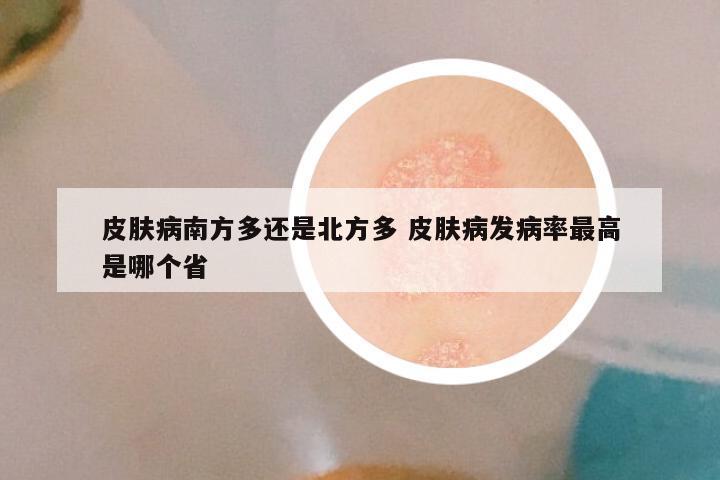 皮肤病南方多还是北方多 皮肤病发病率最高是哪个省