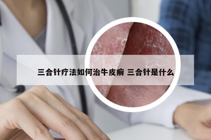 三合针疗法如何治牛皮癣 三合针是什么