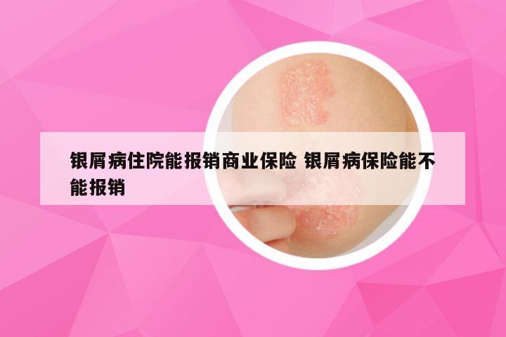 银屑病住院能报销商业保险 银屑病保险能不能报销