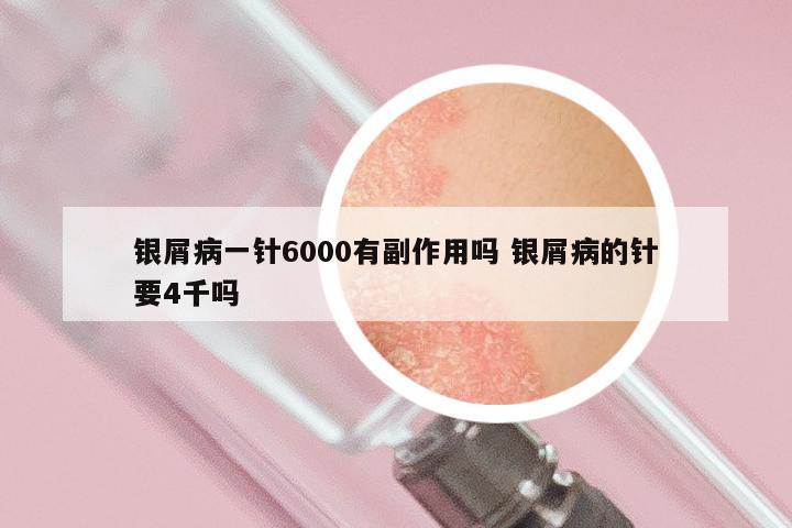 银屑病一针6000有副作用吗 银屑病的针要4千吗