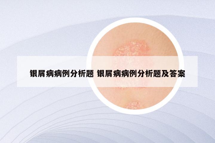 银屑病病例分析题 银屑病病例分析题及答案