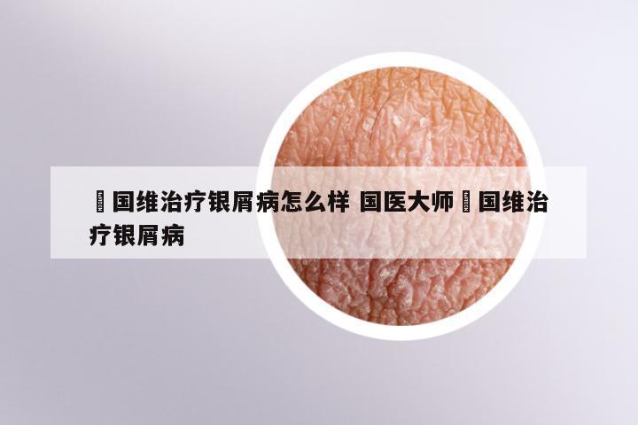 禤国维治疗银屑病怎么样 国医大师禤国维治疗银屑病