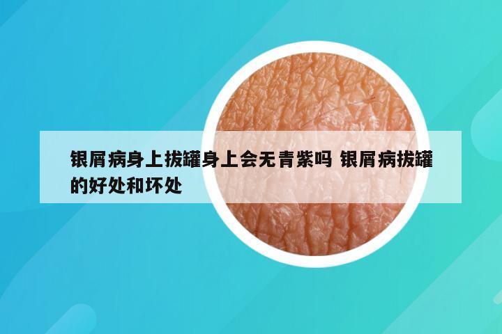 银屑病身上拔罐身上会无青紫吗 银屑病拔罐的好处和坏处