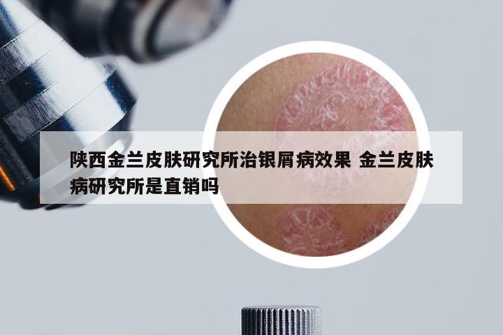 陕西金兰皮肤研究所治银屑病效果 金兰皮肤病研究所是直销吗